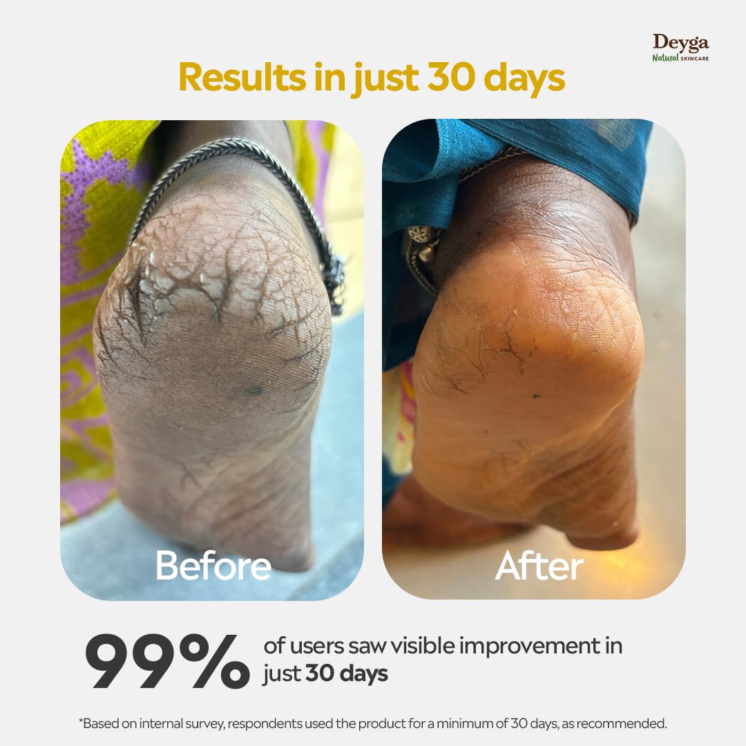 Deyga Foot Butter 40g| Deep Moisturizing Cream for Cracked Heels & Dry Feet
