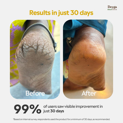 Deyga Foot Butter 40g| Deep Moisturizing Cream for Cracked Heels & Dry Feet